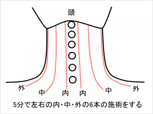 6本の施術をする
